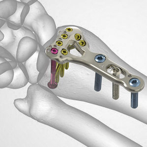 2-placa-radio-distal